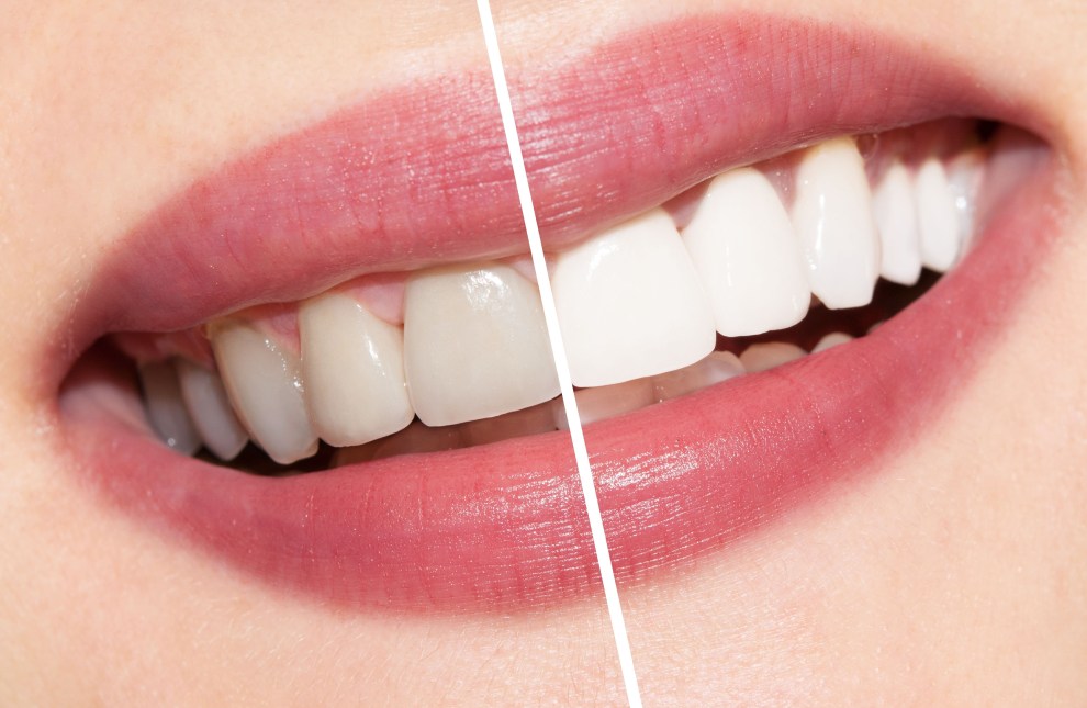 Estética Dental