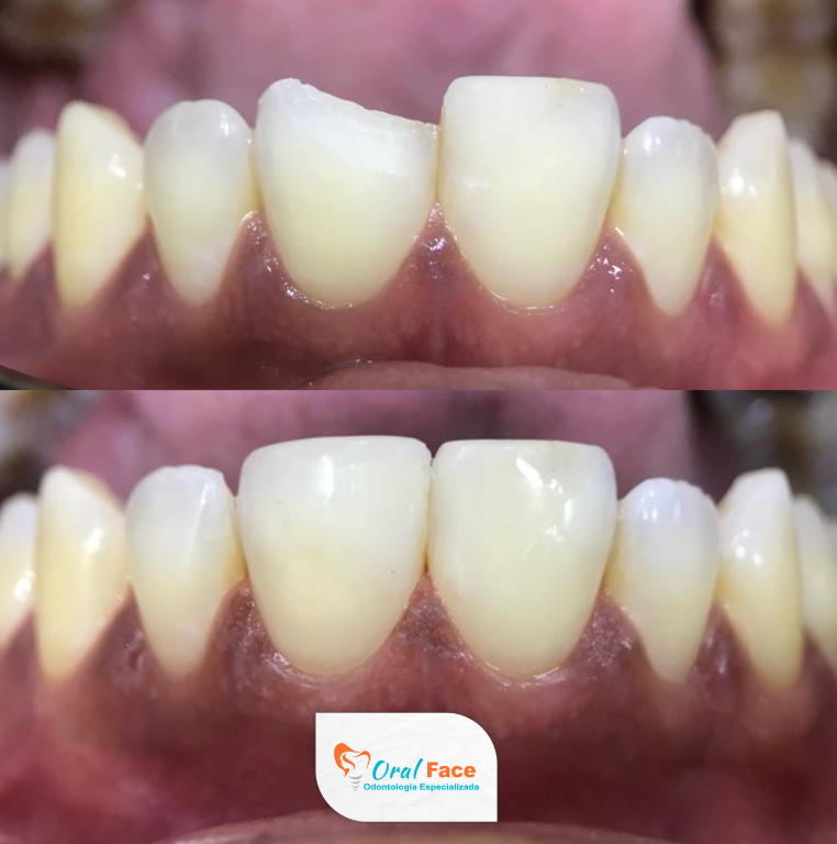 Resultado 1 - Antes e Depois