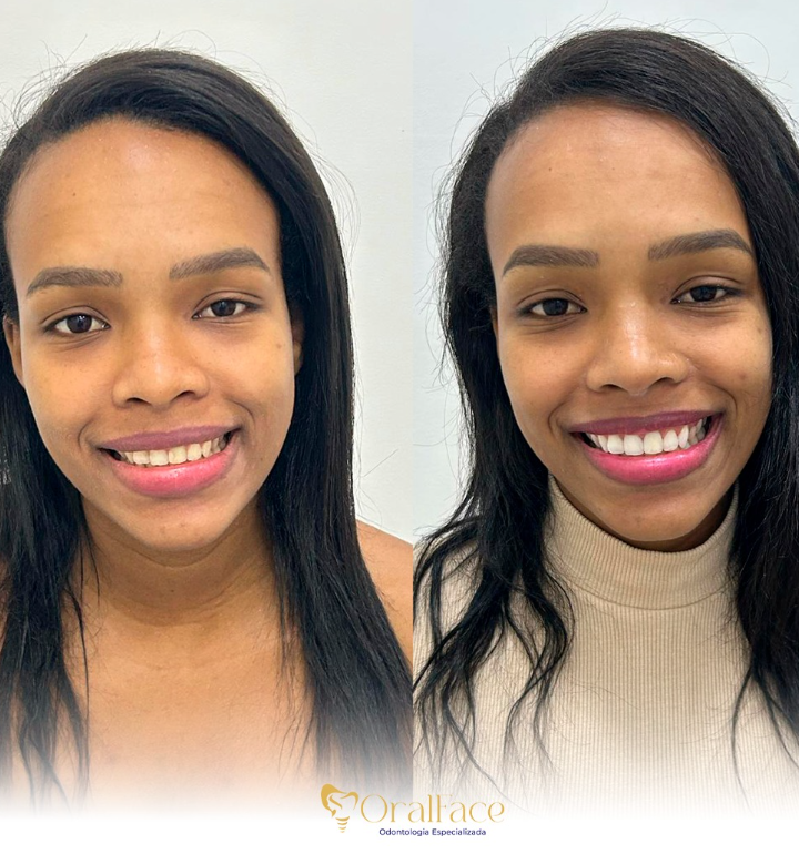 Resultado 4 - Antes e Depois