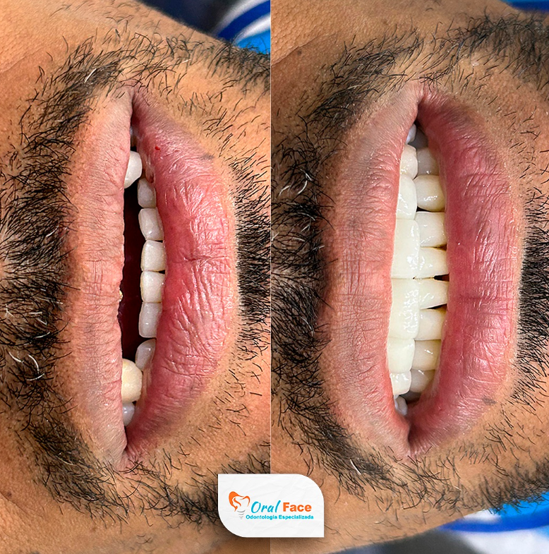 Resultado 2 - Antes e Depois